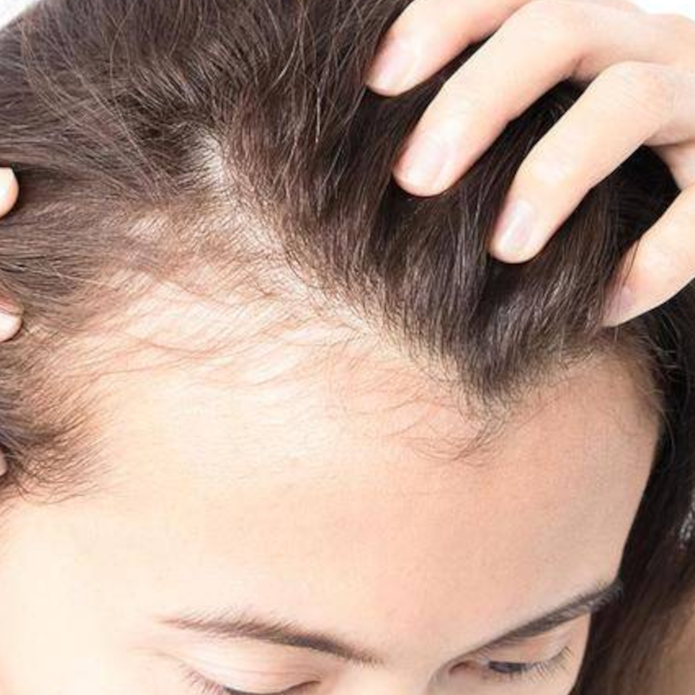 Traction Alopecia