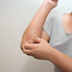 Allergic Reactions and Skin Rash - Waxing Side effects