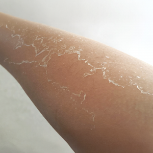 Burns and Surface Skin Peeling