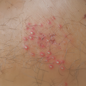 Folliculitis