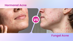 Hormonal Acne Vs Fungal Acne