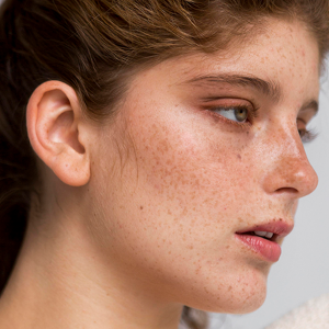 Hyperpigmentation