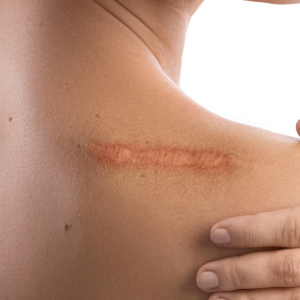 Scarring and Infections