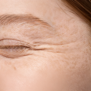 Skin Thinning and Sensitisation