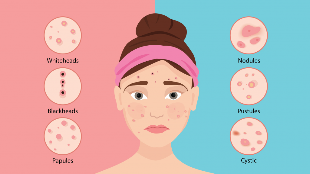 Types of hormonal acne