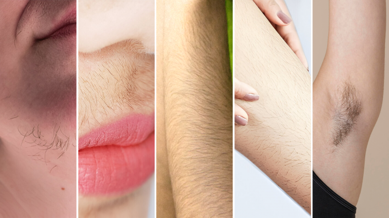 Visual Areas of Unwanted Hair