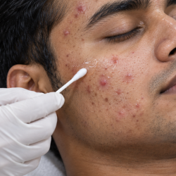 Acne Treatment