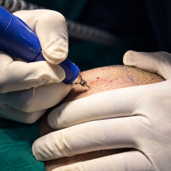 Hair Transplant