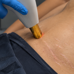 Laser Skin Resurfacing