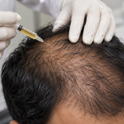 PRP for Hair